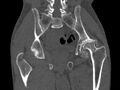Avascular necrosis of the left hip (Radiopaedia 75068-86125 Coronal bone window 53).jpg