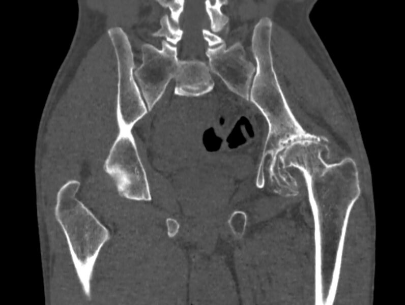 File:Avascular necrosis of the left hip (Radiopaedia 75068-86125 Coronal bone window 53).jpg