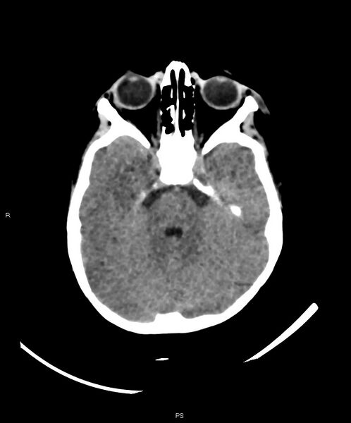 File:Basal ganglia and parenchymal ischemia (Radiopaedia 45818-50083 Axial non-contrast 32).jpg