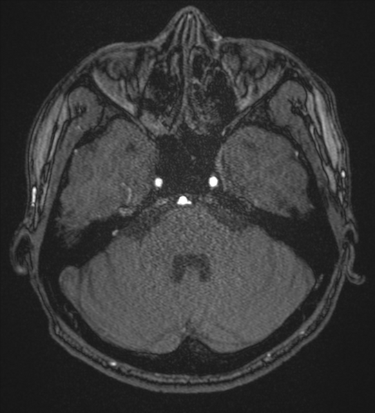 File:Basal ganglia subacute infarct (Radiopaedia 80201-93521 Axial MRA 20).png