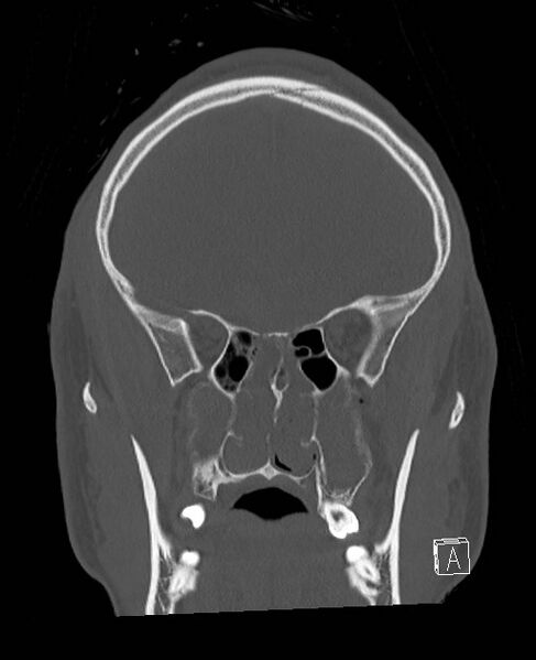 File:Base of skull fracture with bilateral Le Fort fractures (Radiopaedia 47094-51638 Coronal bone window 67).jpg