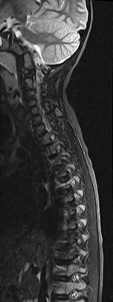 File:Bilateral Sprengel deformity with Klippel-Feil syndrome (Radiopaedia 66395-75650 Sagittal STIR 4).jpg