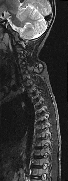 File:Bilateral Sprengel deformity with Klippel-Feil syndrome (Radiopaedia 66395-75650 Sagittal STIR 9).jpg