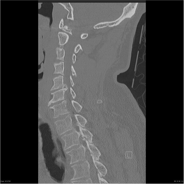 File:Bilateral cervical ribs (Radiopaedia 25868-26017 Sagittal bone window 42).jpg