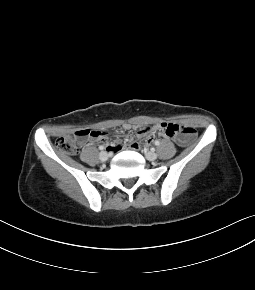 Bilateral kidney malrotation (Radiopaedia 72227-82749 A 50).jpg