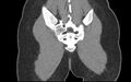 Bilateral mature cystic ovarian teratoma (Radiopaedia 88821-105592 Coronal non-contrast 45).jpg