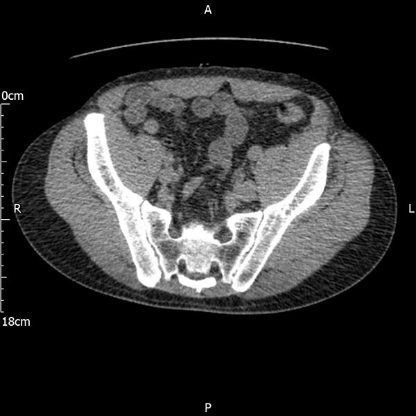 File:Bilateral medullary nephrocalcinosis with ureteric calculi (Radiopaedia 71269-81569 Axial non-contrast 103).jpg