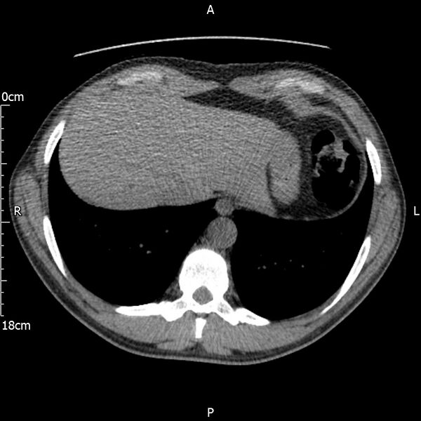 File:Bilateral medullary nephrocalcinosis with ureteric calculi (Radiopaedia 71269-81569 Axial non-contrast 2).jpg