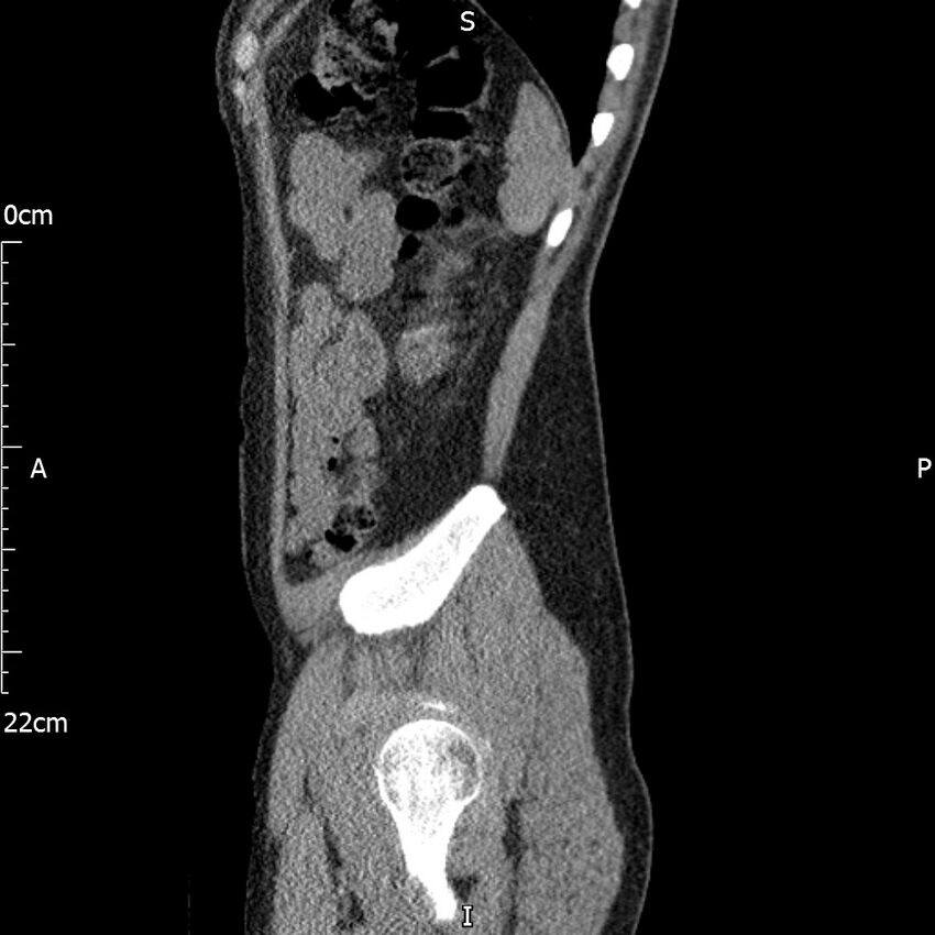 Bilateral medullary nephrocalcinosis with ureteric calculi (Radiopaedia 71269-81569 C 25).jpg