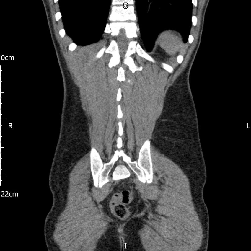 Bilateral medullary nephrocalcinosis with ureteric calculi (Radiopaedia 71269-81569 Coronal non-contrast 62).jpg