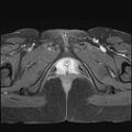 Bilateral ovarian endometriomas (Radiopaedia 87085-103347 Axial T1 C+ fat sat 23).jpg