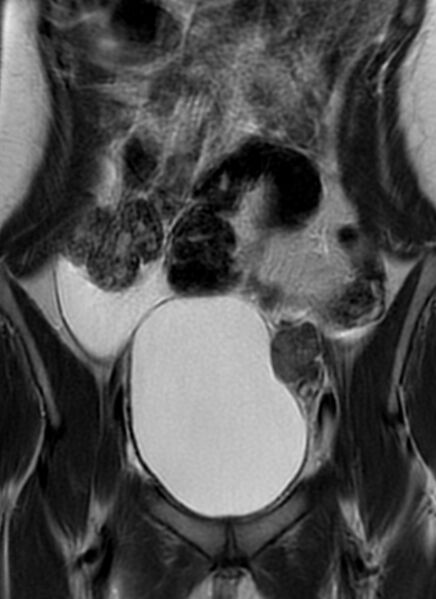 File:Bilateral ovarian fibrothecomas - adolescent (Radiopaedia 86604-102707 Coronal T2 11).jpg