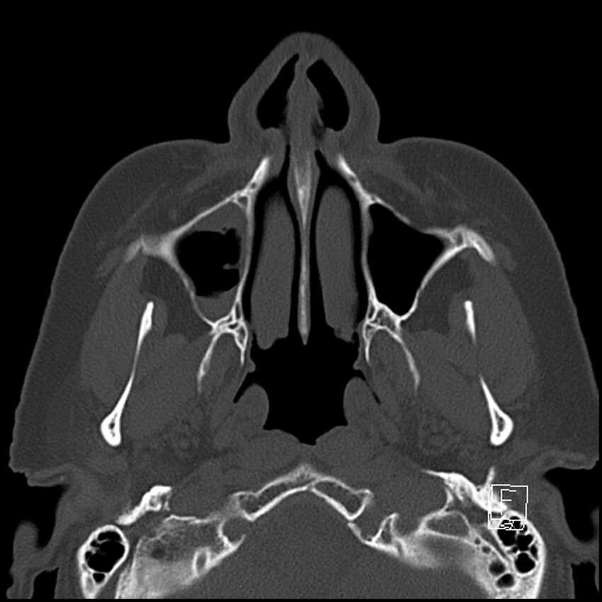 Bilateral palatine tonsilloliths on OPG and CT (Radiopaedia 75167-86247 Axial bone window 26).jpg