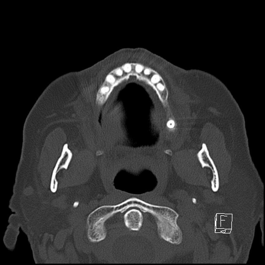 Bilateral palatine tonsilloliths on OPG and CT (Radiopaedia 75167-86247 Axial bone window 34).jpg