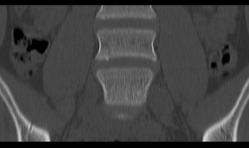 File:Bilateral pars defect (Radiopaedia 26691-26846 Coronal bone window 14).jpg