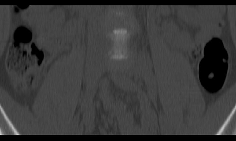 File:Bilateral pars defect (Radiopaedia 26691-26846 Coronal bone window 5).jpg