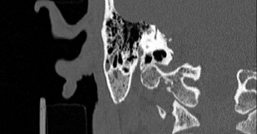 Bilateral temporal bone fractures (Radiopaedia 29482-29970 Coronal non-contrast 134).jpg