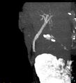 Bile leak from accessory duct(s) of Luschka post cholecystectomy (Radiopaedia 40736-43389 D 24).jpg