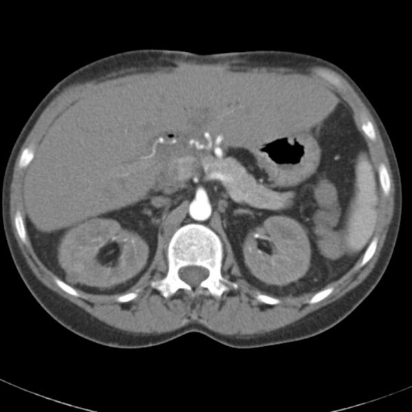 File:Biliary necrosis - liver transplant (Radiopaedia 21876-21845 A 20).jpg