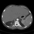 Biliary necrosis - liver transplant (Radiopaedia 21876-21846 A 15).jpg