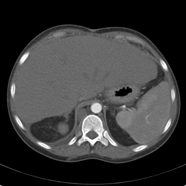File:Biliary necrosis - liver transplant (Radiopaedia 21876-21846 A 15).jpg