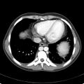 Biliary necrosis - liver transplant (Radiopaedia 21876-21846 B 4).jpg