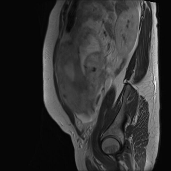 File:Bilobed placenta accreta (Radiopaedia 69648-79591 Sagittal T2 7).jpg