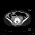 Bochdalek diaphragmatic hernia (Radiopaedia 38866-41059 A 38).jpg