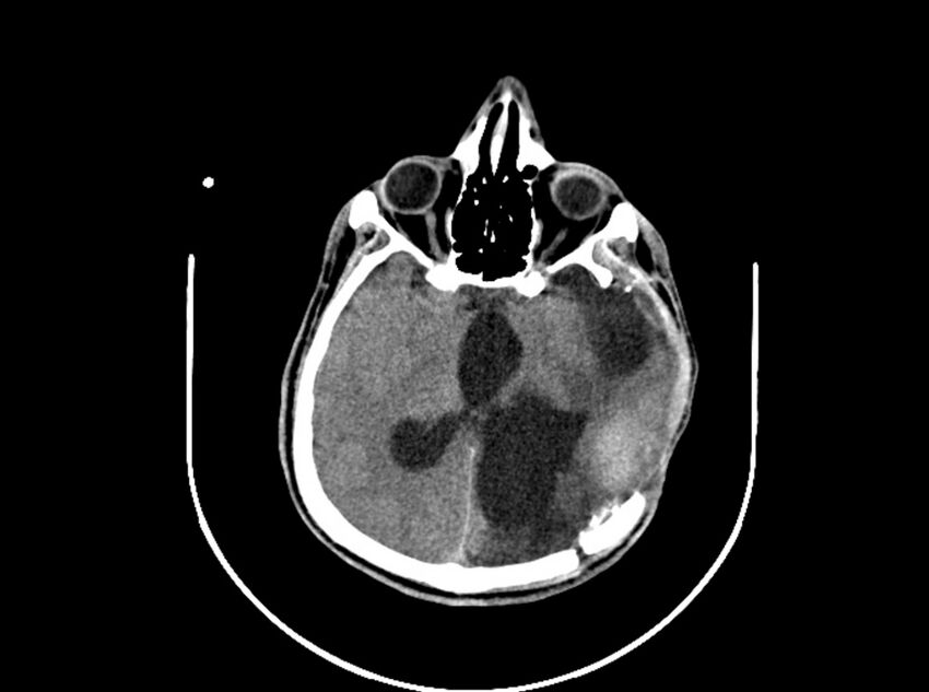 Brain injury by firearm projectile (Radiopaedia 82068-96088 A 124).jpg