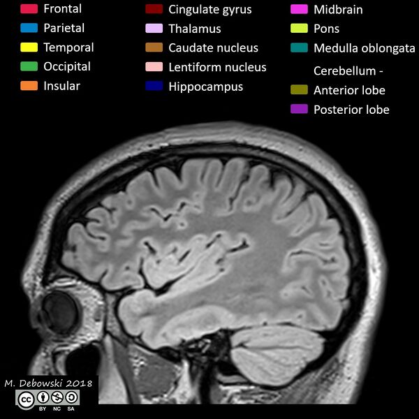 File:Brain lobes - annotated MRI (Radiopaedia 61691-69700 Sagittal 17).JPG