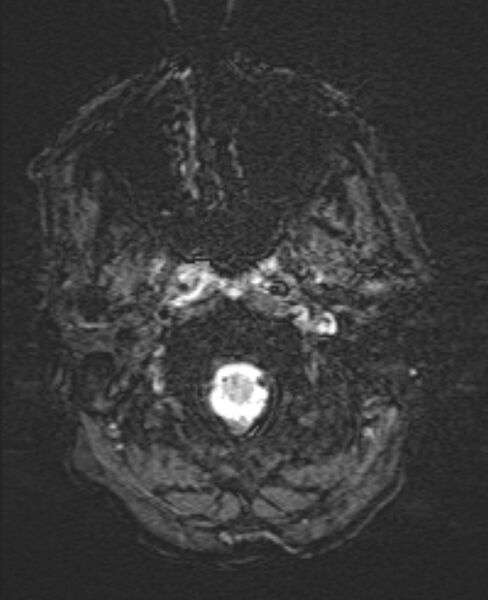 File:Brain metastases - lung cancer primary (Radiopaedia 75060-86115 Axial SWI 4).jpg
