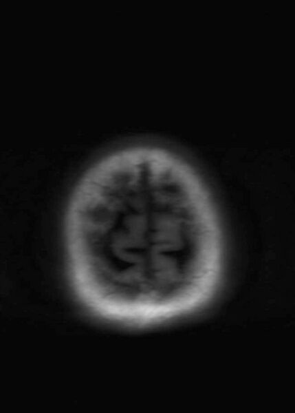 File:Brain metastases from squamocellular lung cancer (Radiopaedia 56515-63222 Axial T1 23).jpg