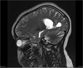 Brainstem glioma (Radiopaedia 21819-21775 Sagittal T2 7).jpg