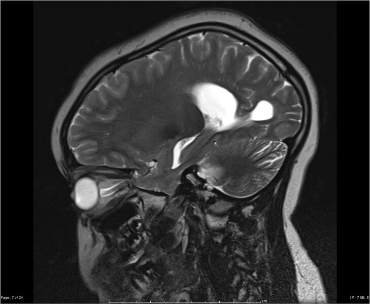 File:Brainstem glioma (Radiopaedia 21819-21775 Sagittal T2 7).jpg