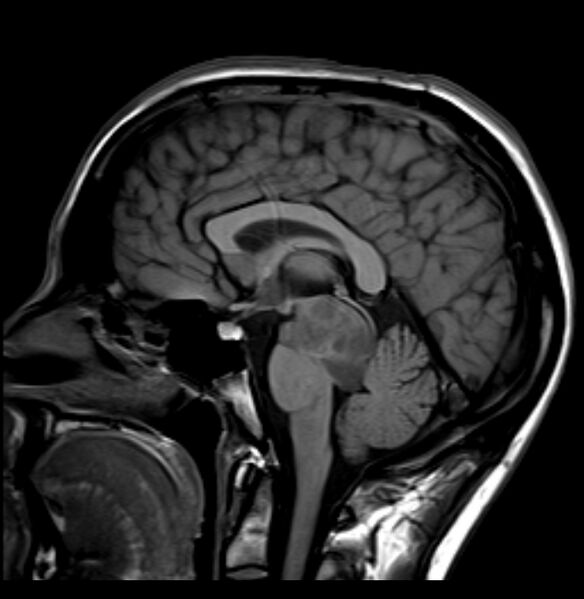 File:Brainstem glioma - focal midbrain (Radiopaedia 6525-67551 Sagittal T1 1).jpg