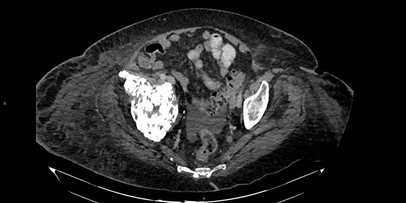 File:Breast cancer pelvic bony metastases (Radiopaedia 84470-99824 Axial bone window 46).jpg
