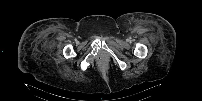 File:Breast cancer pelvic bony metastases (Radiopaedia 84470-99824 Axial bone window 75).jpg