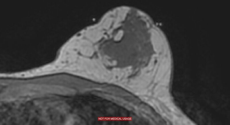 File:Breast lymphoma (MRI) (Radiopaedia 34999-36498 Axial T1 2).jpg