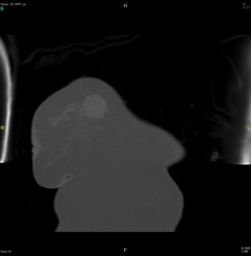 Breast primary with lung and bone metastases (Radiopaedia 40620-43228 bone window 9).jpg