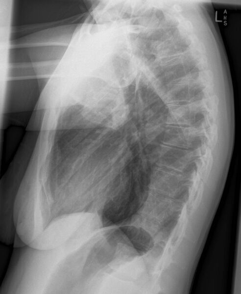 File:Bronchial carcinoid tumor (Radiopaedia 15042-14942 Lateral 1).jpg