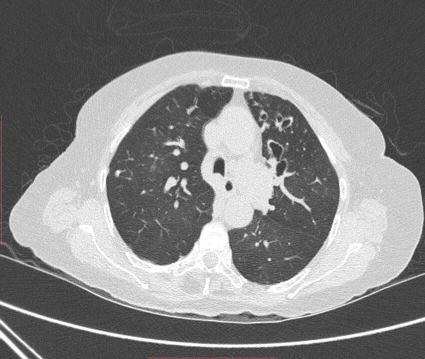 Bronchiectasis (Radiopaedia 72693-83293 Axial lung window 44).jpg