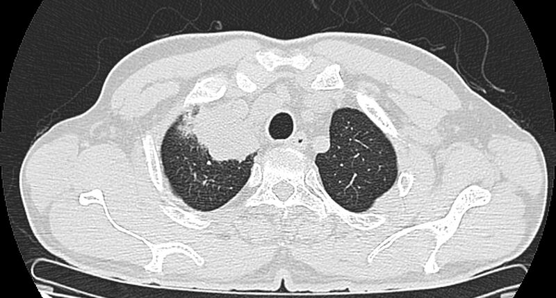 File:Bronchogenic carcinoma with superior vena cava syndrome (Radiopaedia 36497-38054 Axial lung window 15).jpg