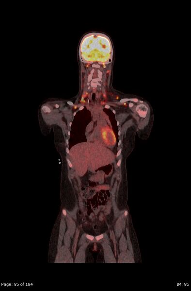 File:Brown fat uptake (FDG PET-CT) (Radiopaedia 77392-89513 Fused coronal 43).jpg