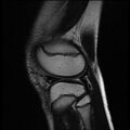 Bucket handle tear - lateral meniscus (Radiopaedia 72124-82634 Sagittal T2 3).jpg