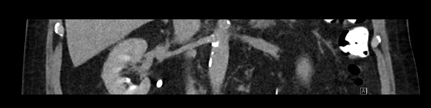Buried bumper syndrome - gastrostomy tube (Radiopaedia 63843-72575 Coronal Inject 54).jpg