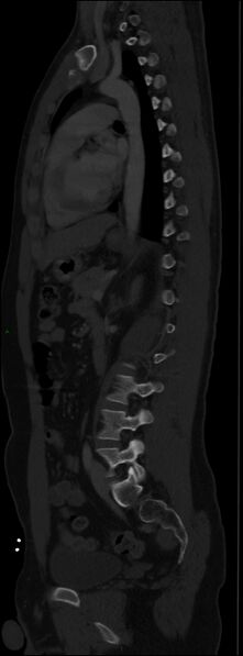File:Burst fracture (Radiopaedia 83168-97542 Sagittal bone window 76).jpg