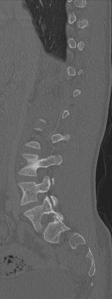 File:Burst fracture - T12 with conus compression (Radiopaedia 56825-63647 Sagittal bone window 57).png