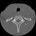 C5 facet fracture (Radiopaedia 58374-65499 Axial bone window 80).jpg