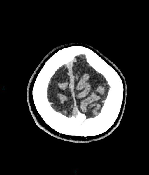 File:Calcified cerebral emboli from left ventricular thrombus (Radiopaedia 84420-99758 Axial non-contrast 11).jpg