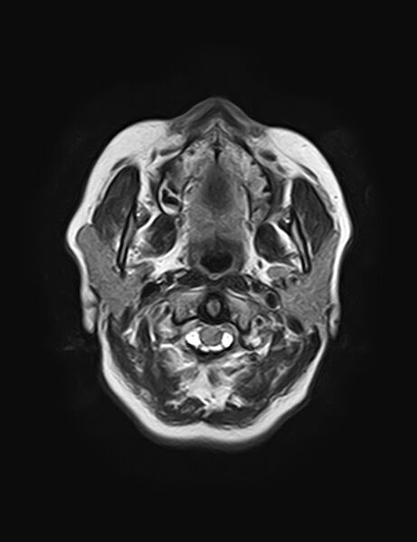 File:Calcified cerebral hydatid cyst (Radiopaedia 65603-74699 Axial FLAIR 1).jpg